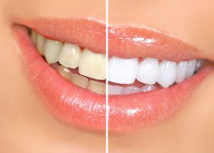 Teeth Whitening Secrets Revealed!